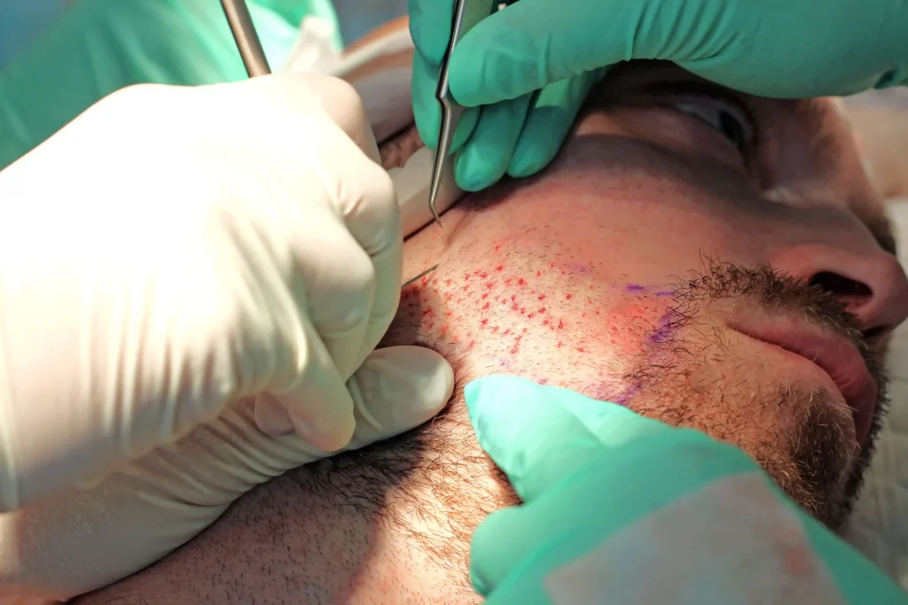 Haartransplantatie Wouter van Dort 2 Wouter Haartransplantatie