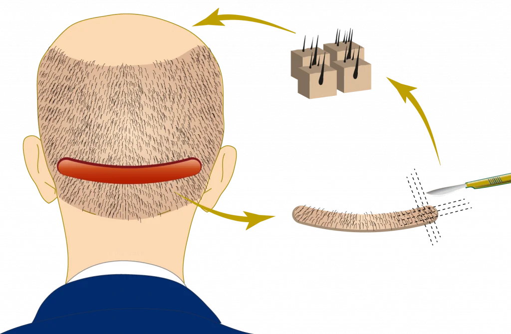 Fut Haartransplantatie methode Illustratie