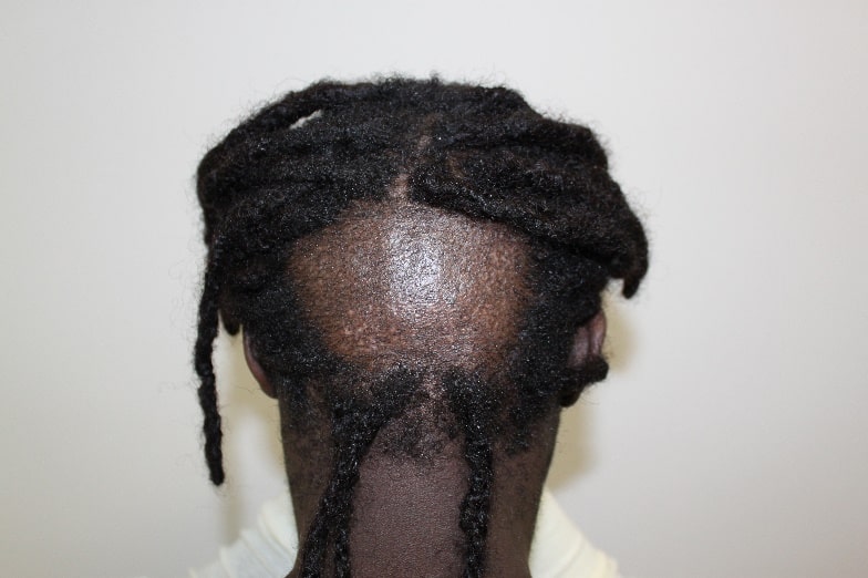 Kroeshaar Haartransplantatie Acherhoofd