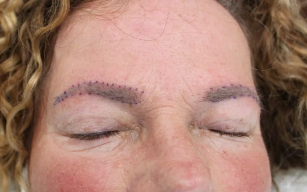 Kosten haartransplantatie wenkbrauw