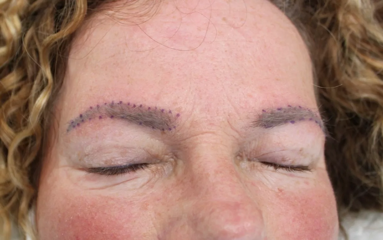 Kosten haartransplantatie wenkbrauw