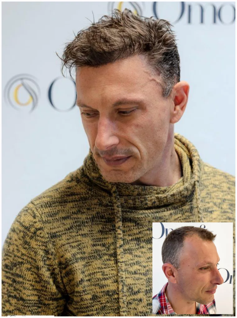haartransplantatie mannen voorbeeld 2