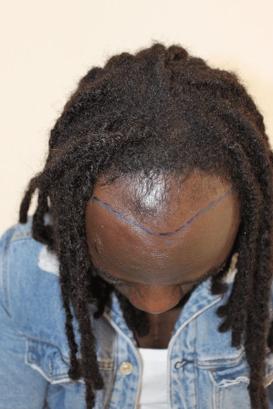 haartransplantatie in Utrecht