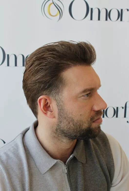 snortransplantatie baardtransplantatie