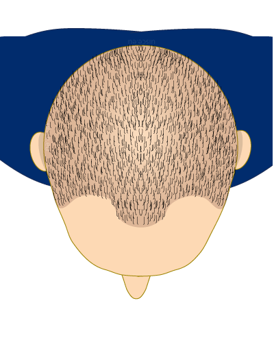 haartransplantatie mannen