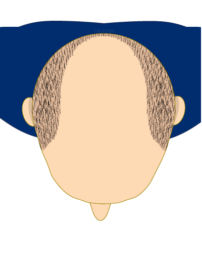 volledige haartransplantatie mannen