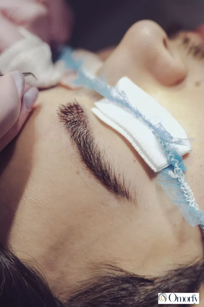 haartransplantatie vrouwen
