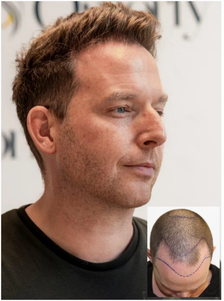 Resultaat haartransplantatie Omorfy
