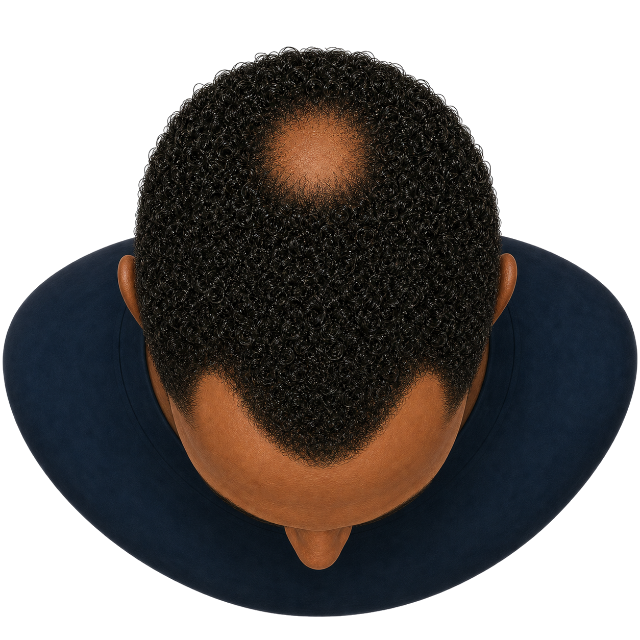 Herstelbehandeling Haartransplantatie Uitgebreid