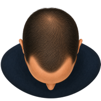 Herstelbehandeling Haartransplantatie inhammen