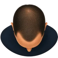 Herstelbehandeling Haartransplantatie inhammen