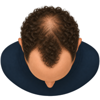 Herstelbehandeling Haartransplantatie krullen