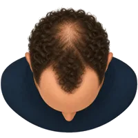 Herstelbehandeling Haartransplantatie krullen