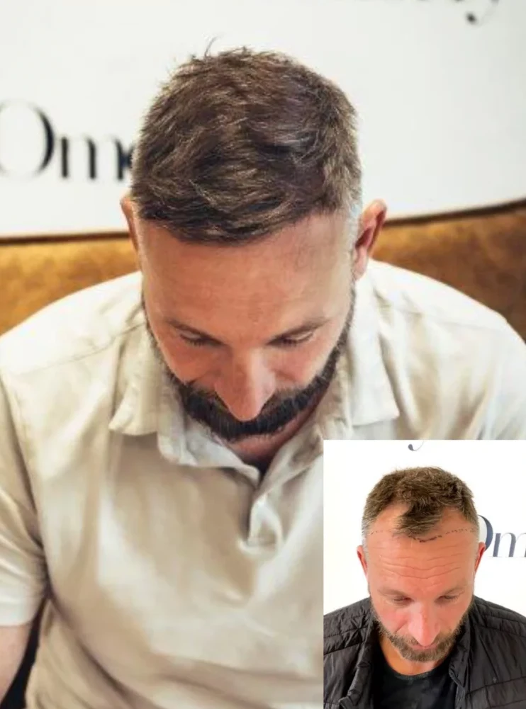 Resultaat haartransplantatie Omorfy