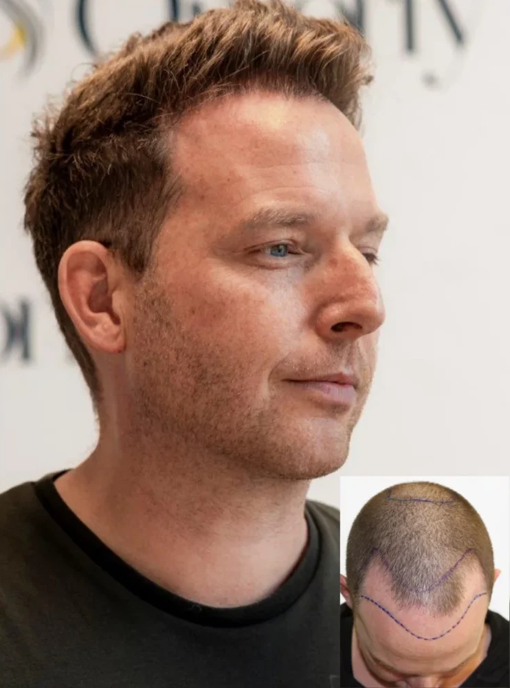 Resultaat haartransplantatie Omorfy